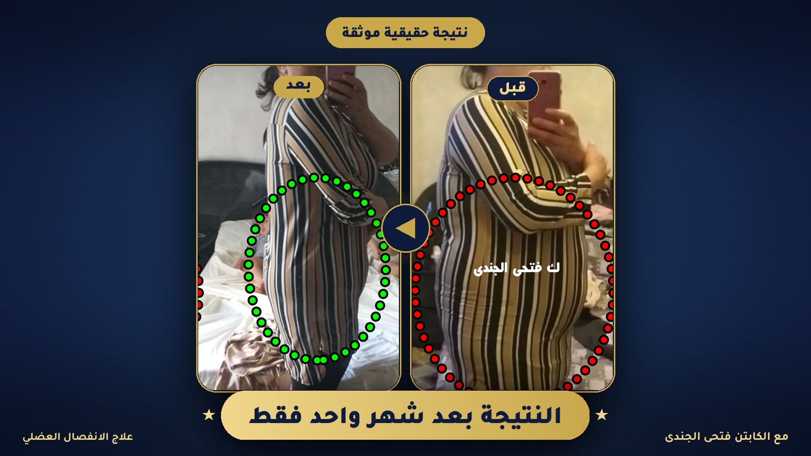 نتيجة كورس علاج الانفصال العضلي — قبل و بعد شهر واحد